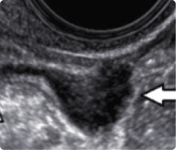 Endometriosis