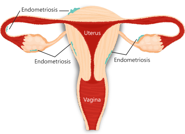 What is Endometriosis