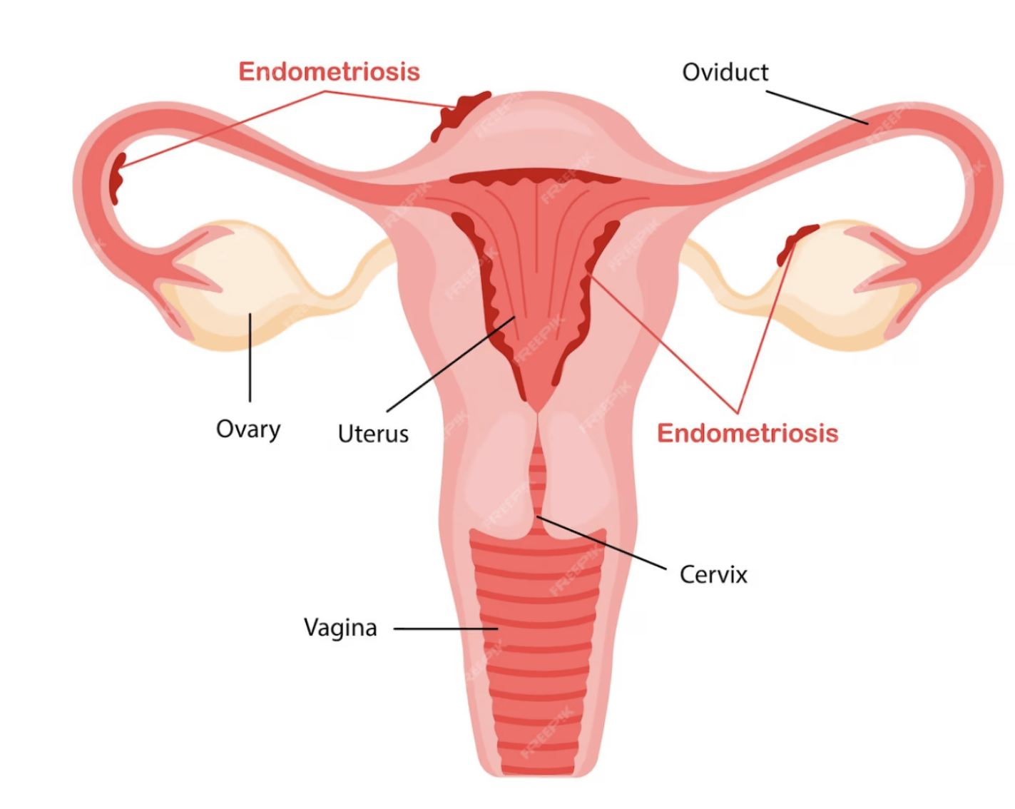 Endometriosis location in body