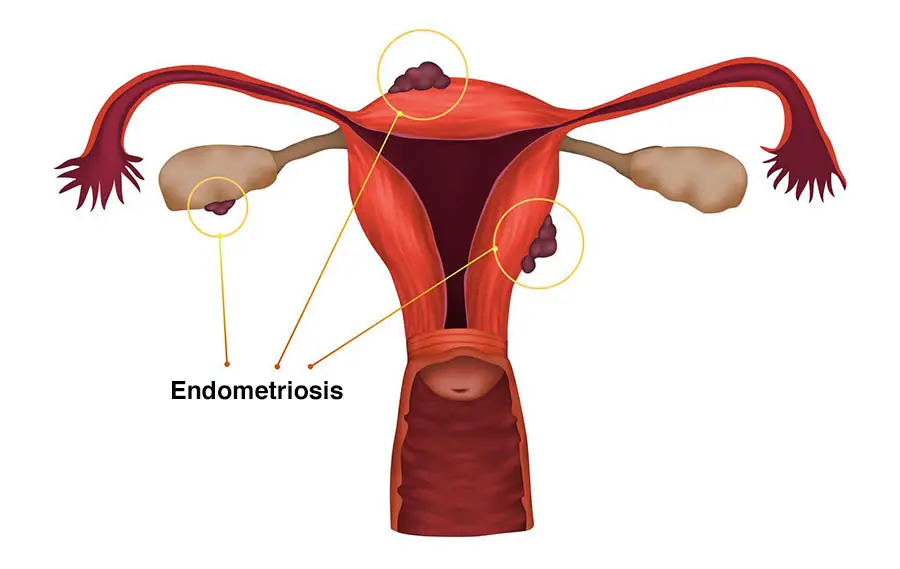 What is Endometriosis symptoms, Showing in illustration form