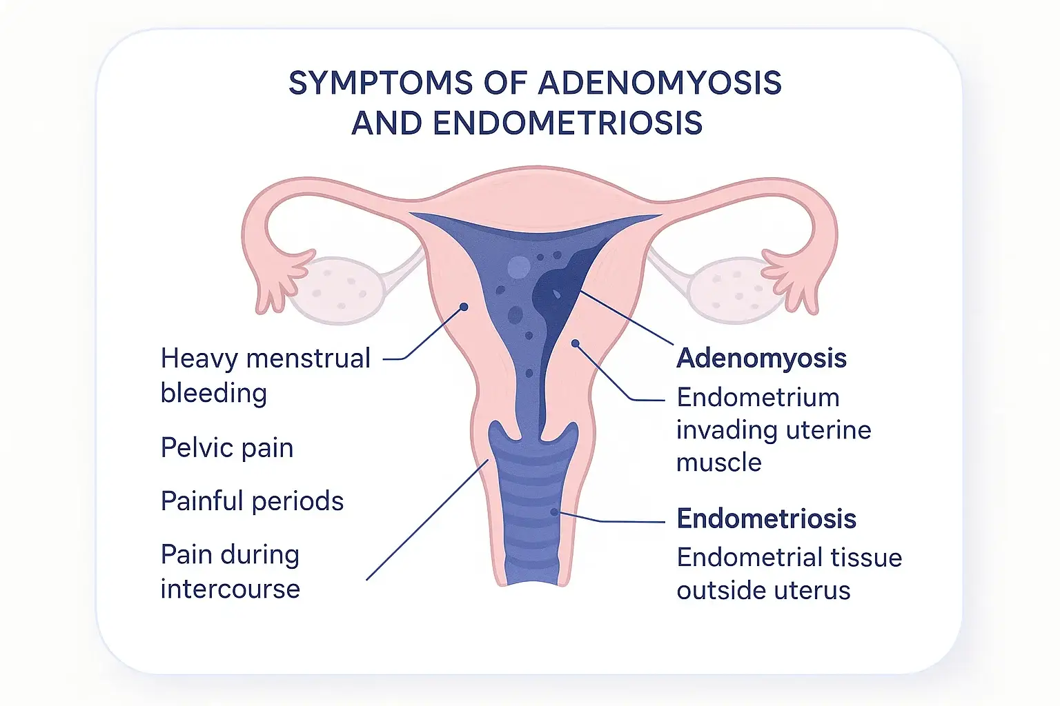 Illustration showing issues due to adenomyosis and endometriosis in and around the uterus.