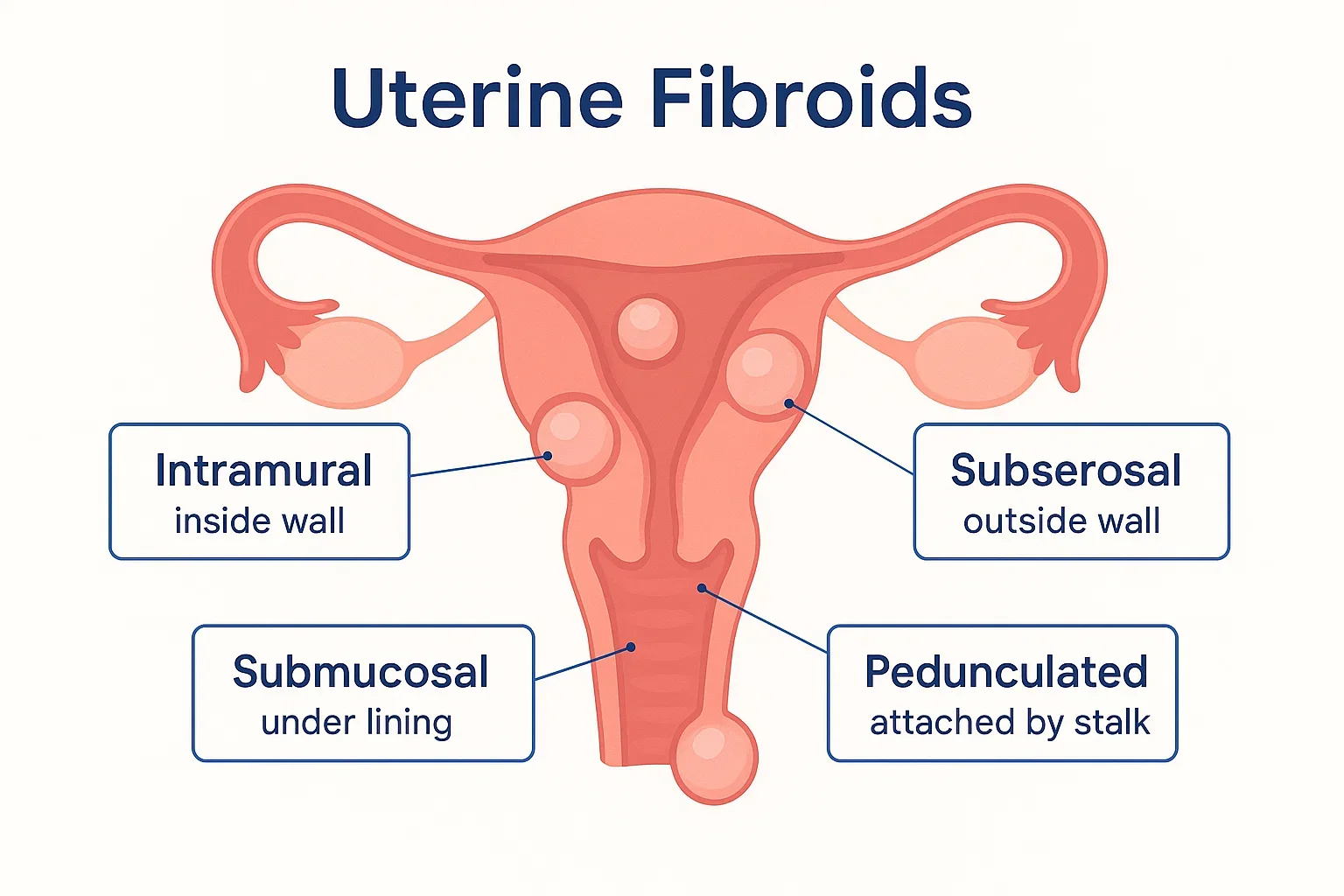Infographic of uterus showing different fibroid types-intramural, subserosal, submucosal, and pedunculated.