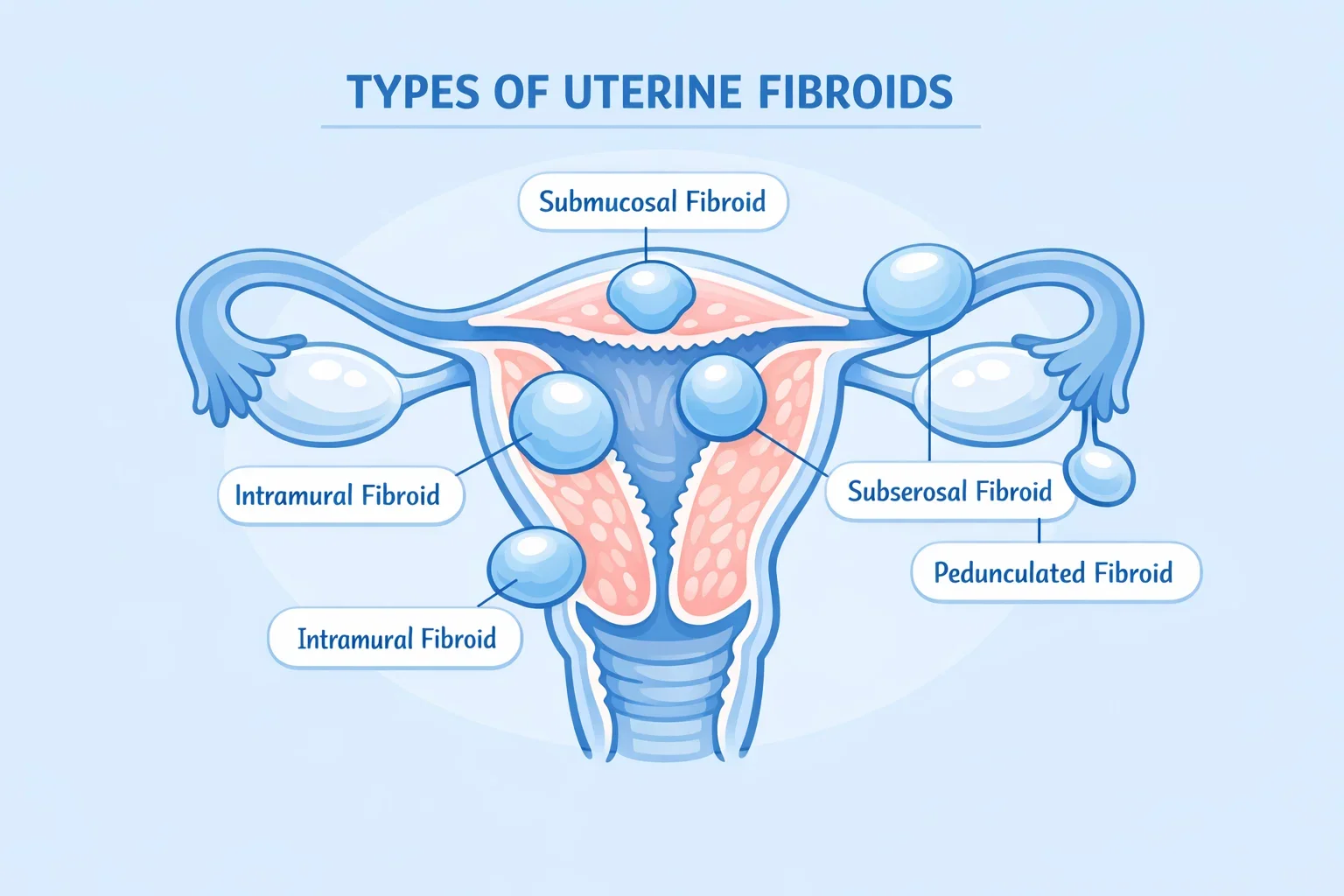 Diagram explaining different types of uterine fibroids based on their location in the uterus.