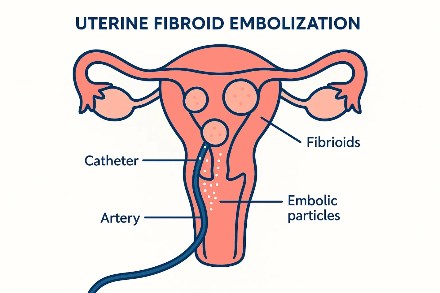 Medical illustration showing how uterine fibroid embolization (UFE) blocks blood supply to shrink fibroids.