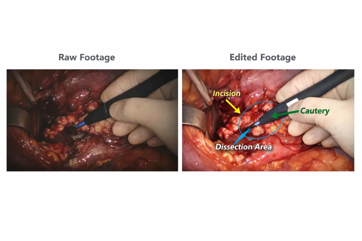 Comparison of raw and professionally edited surgical video demonstrating improved clarity and annotations.