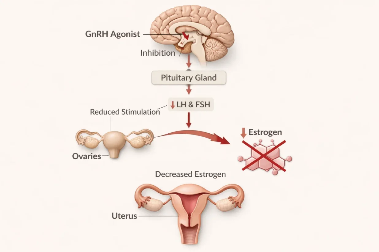 Medical graphic showing how GnRH agonist therapy reduces estrogen levels in endometriosis.