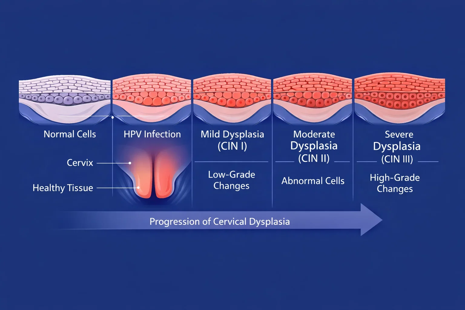 Medical illustration showing HPV infection and cervical cell changes leading to cancer.